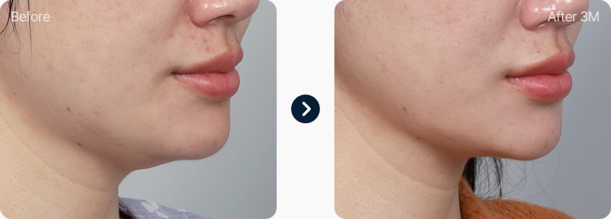 Double chin liposuction before and after results – improved jawline contour after 3 months
