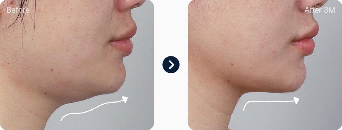 Double chin liposuction before and after results – improved jawline contour after 3 months