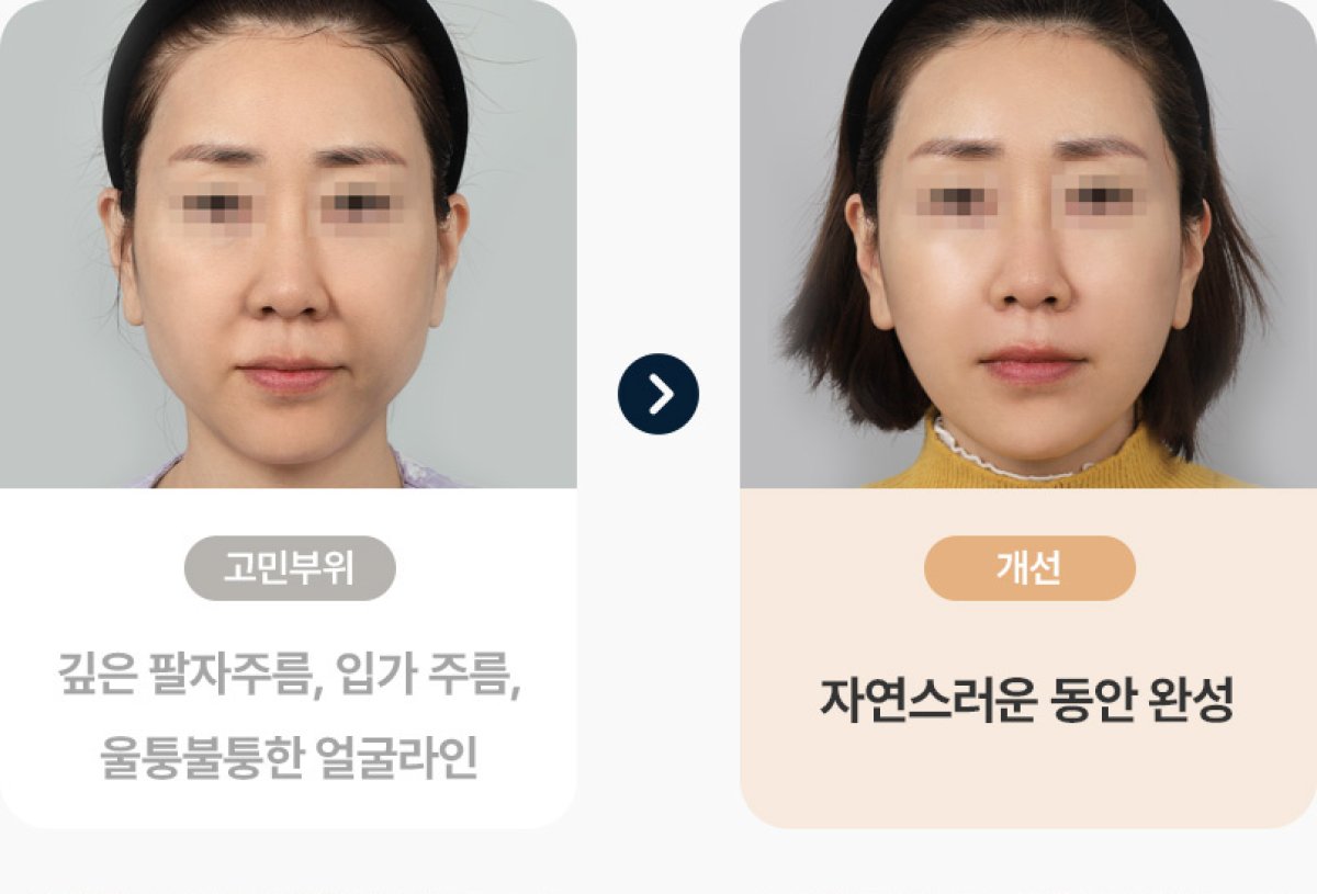 Résultats avant/après PRP – réduction des rides et peau du visage plus lisse