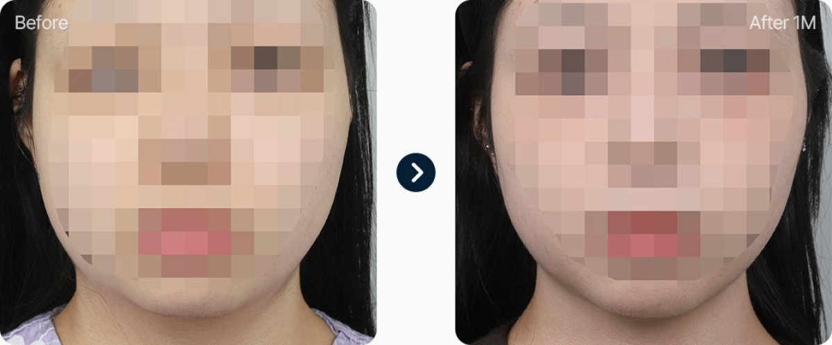 Résultats avant et après PRP pour rajeunissement facial, amélioration visible après 1 mois