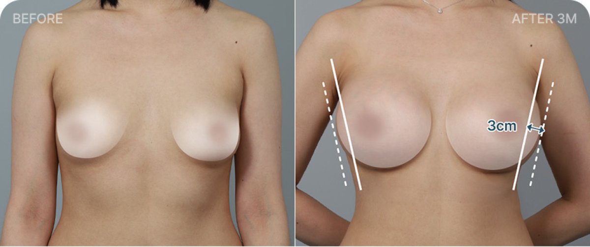 Before and after breast lift results – improved breast shape and symmetry after 3 months
