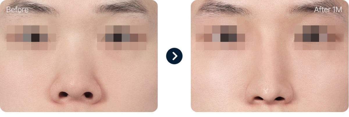 نتائج تجميل الأنف قبل وبعد، تحسين شكل وتناسق الأنف بعد شهر واحد