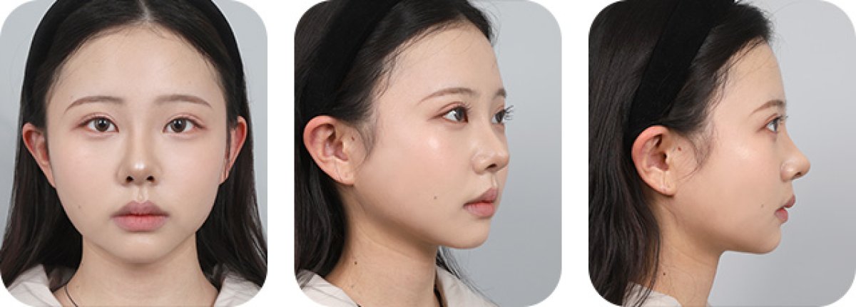 نتائج عملية تجميل الأنف قبل وبعد، إعادة تشكيل الأنف لتحسين تناسق الوجه