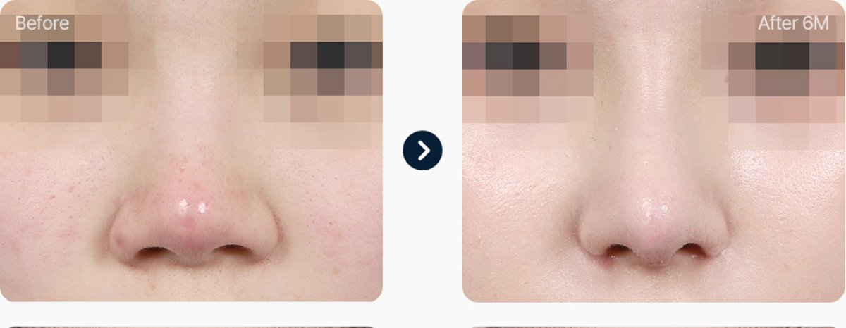 Before and after tip rhinoplasty results, refined nose tip appearance after 6 months