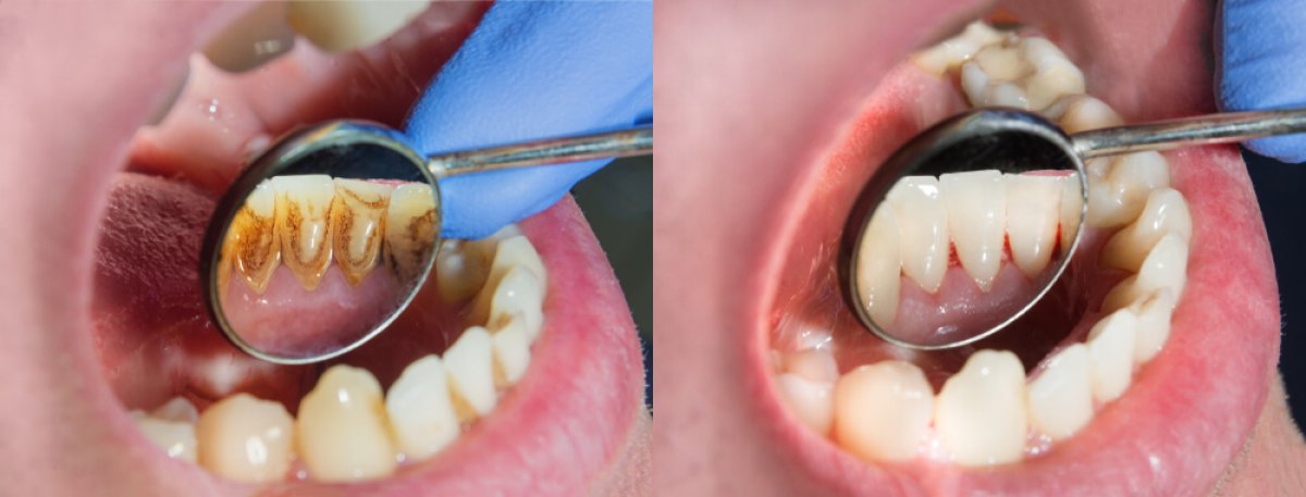Before and after deep cleaning results at ClinicHI Dental Health Center Istanbul, tartar removal