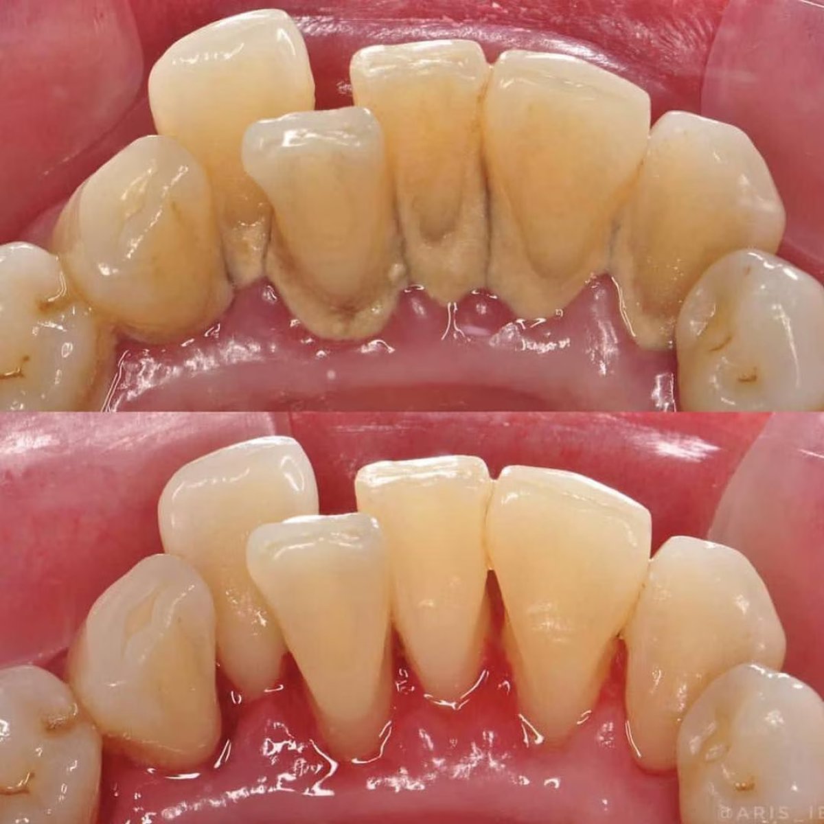 Before and after teeth cleaning (scaling) result at ClinicHI Dental Health Center Istanbul