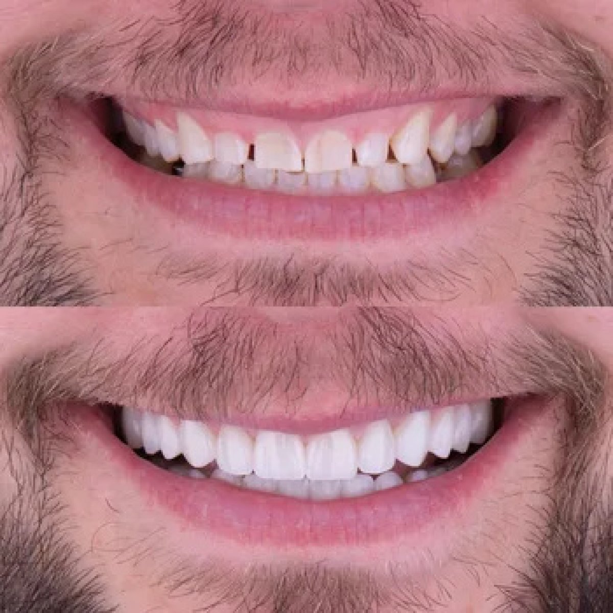 Результаты до и после улыбки в ClinicHI Dental Health Center Istanbul, улучшенные зубы