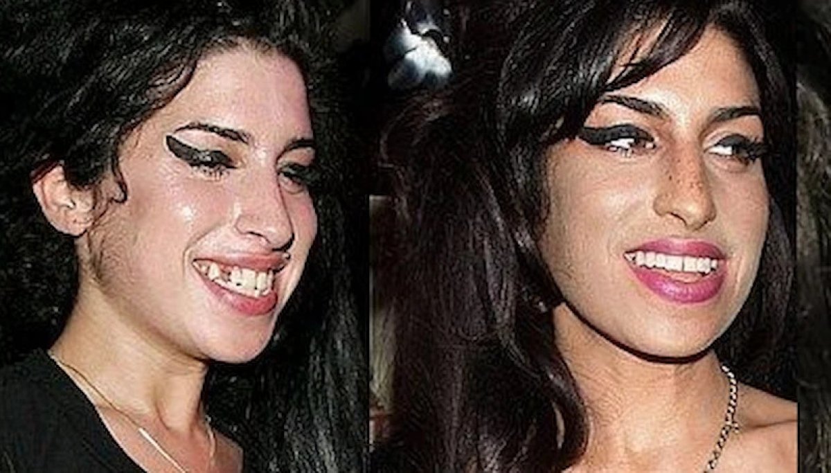 Before and after dental implant results at ClinicHI Dental Health Center Istanbul, improved smile