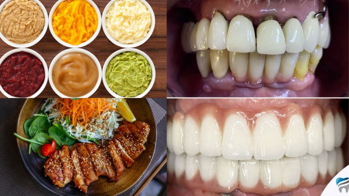 Resultados antes y después de implantes All-on-4 en ClinicHI Dental Health Center Estambul
