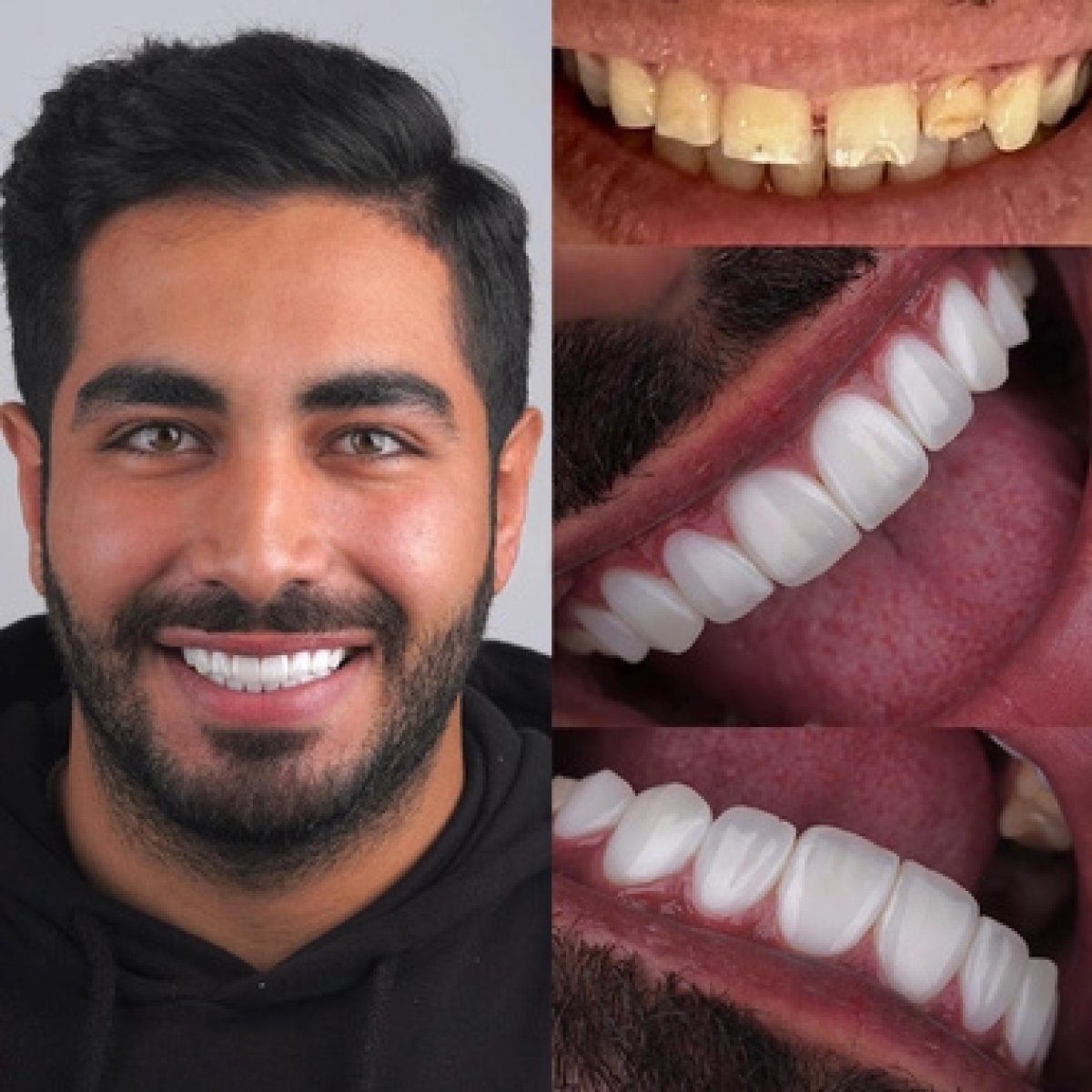 Результаты до и после установки виниров в ClinicHI Dental Health Center Istanbul, улыбка