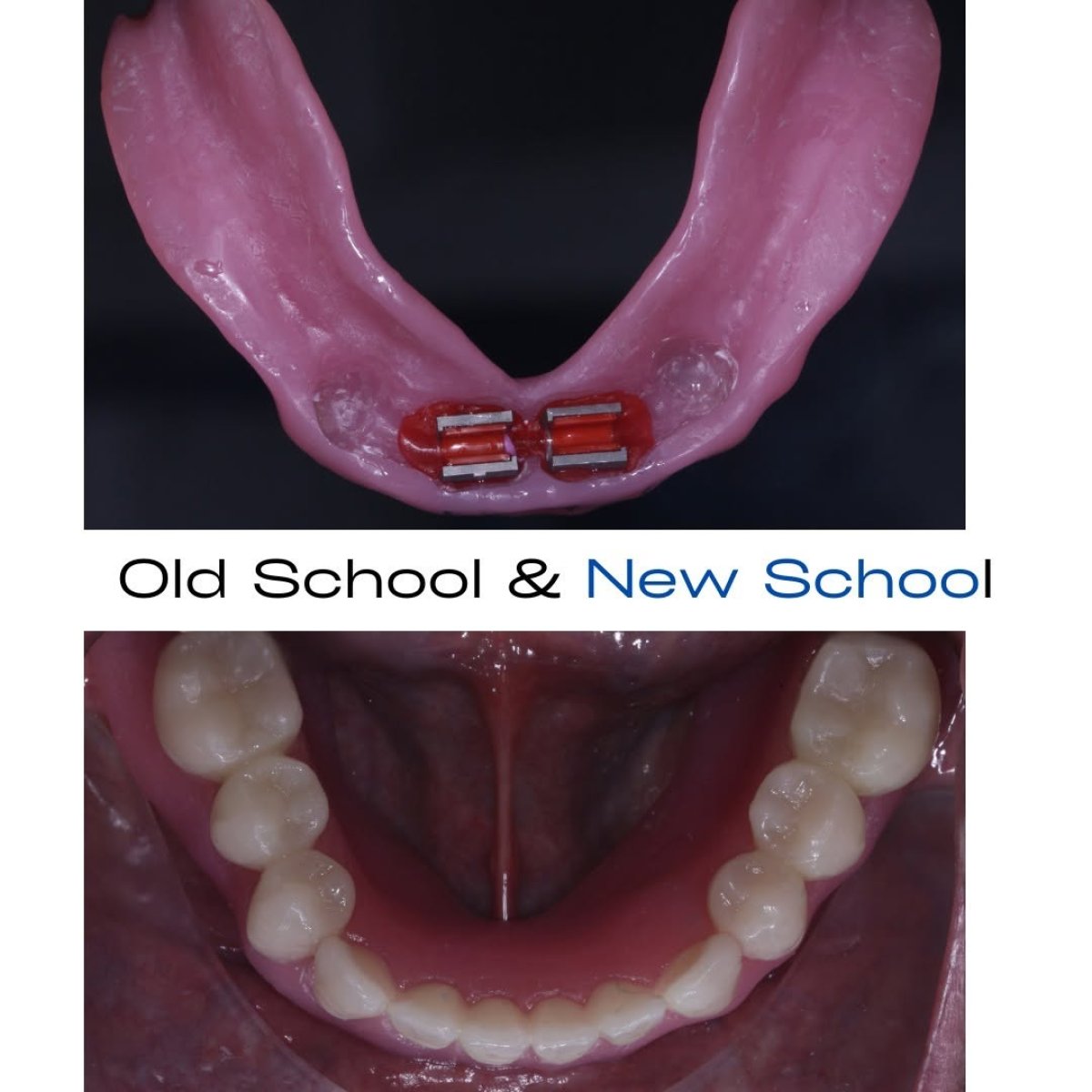 All-on-4 dental implants before and after results – improved lower jaw teeth restoration