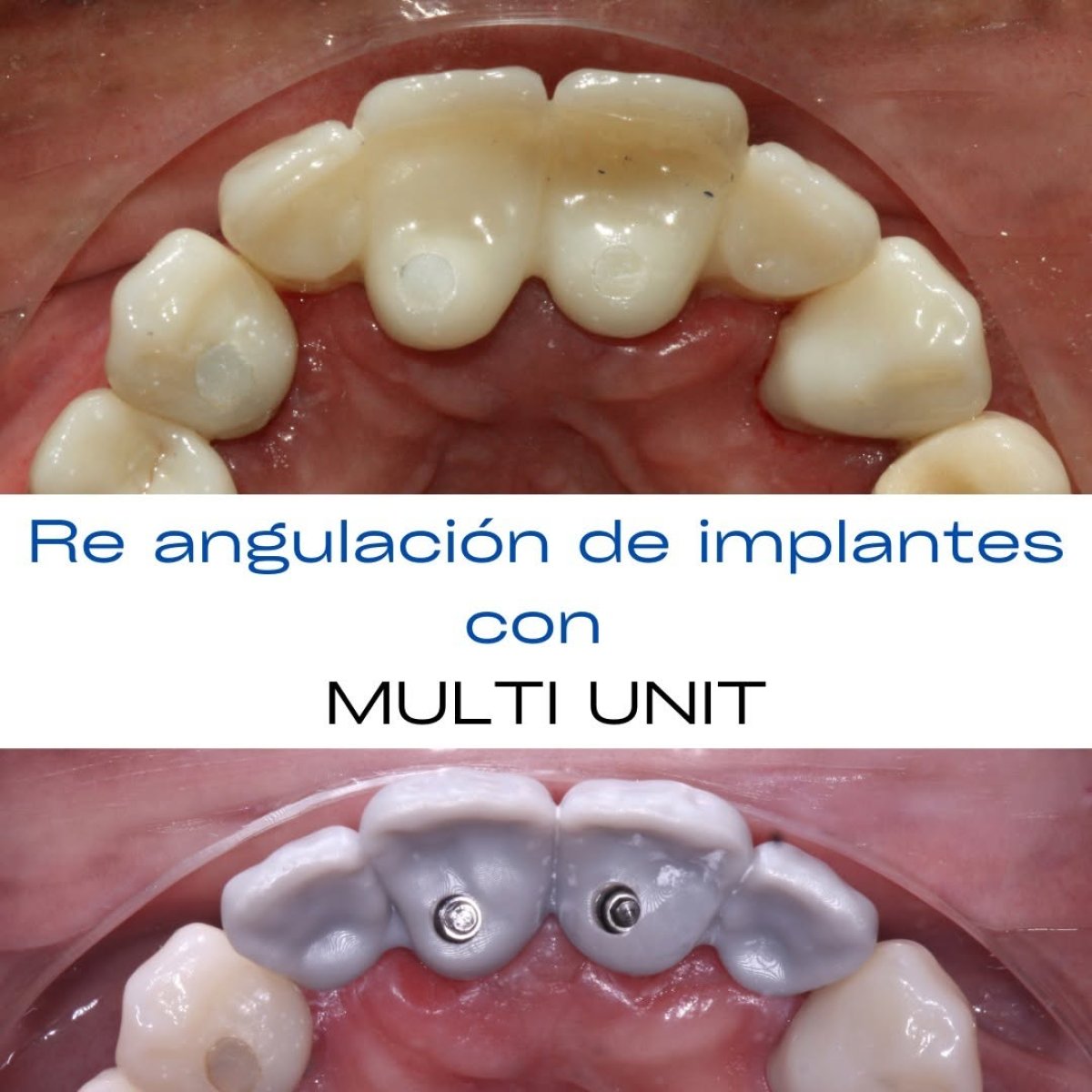 Resultado de corrección de angulación de implantes dentales con multi unit