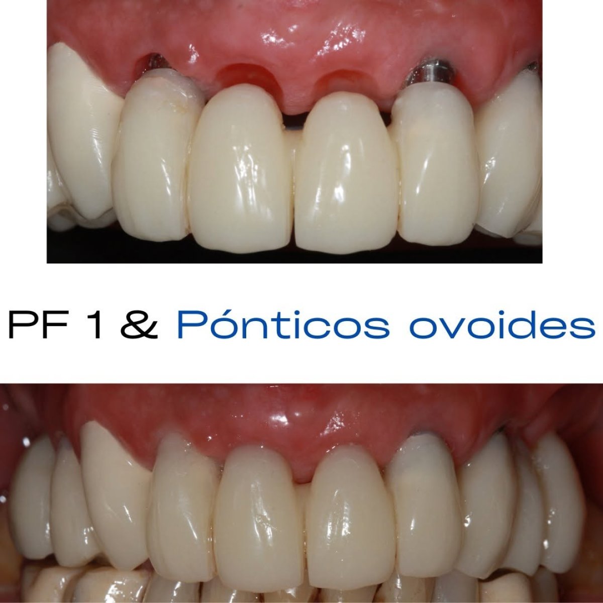 Before and after dental implant with crown results, improved front teeth restoration