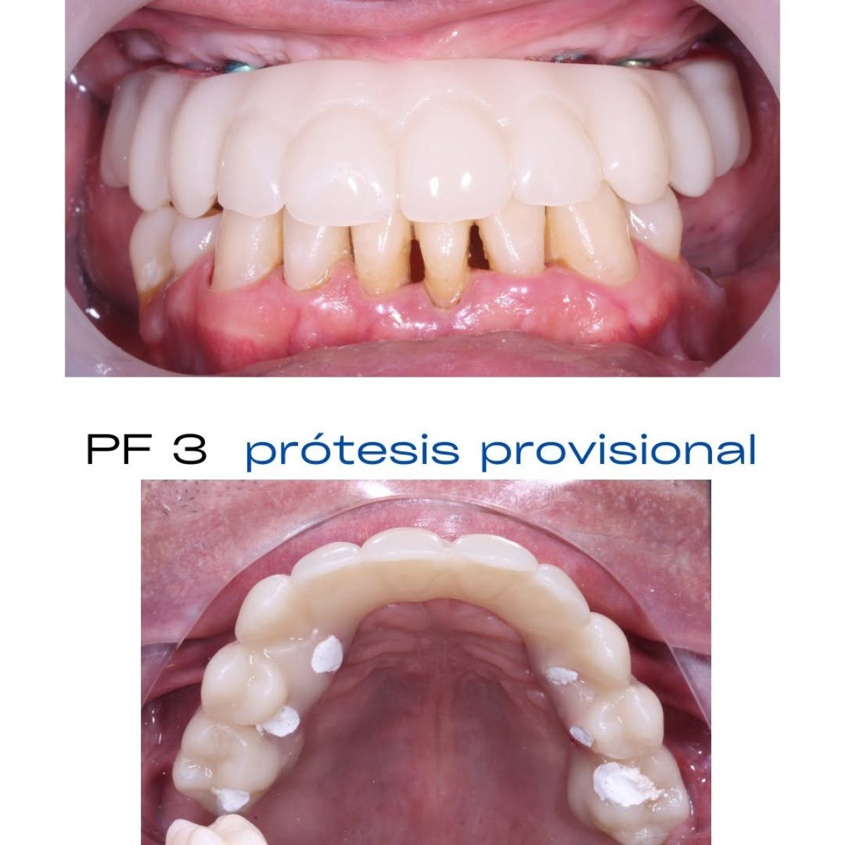 Resultado de instalación de prótesis dental: mejora de dientes superiores con prótesis provisional