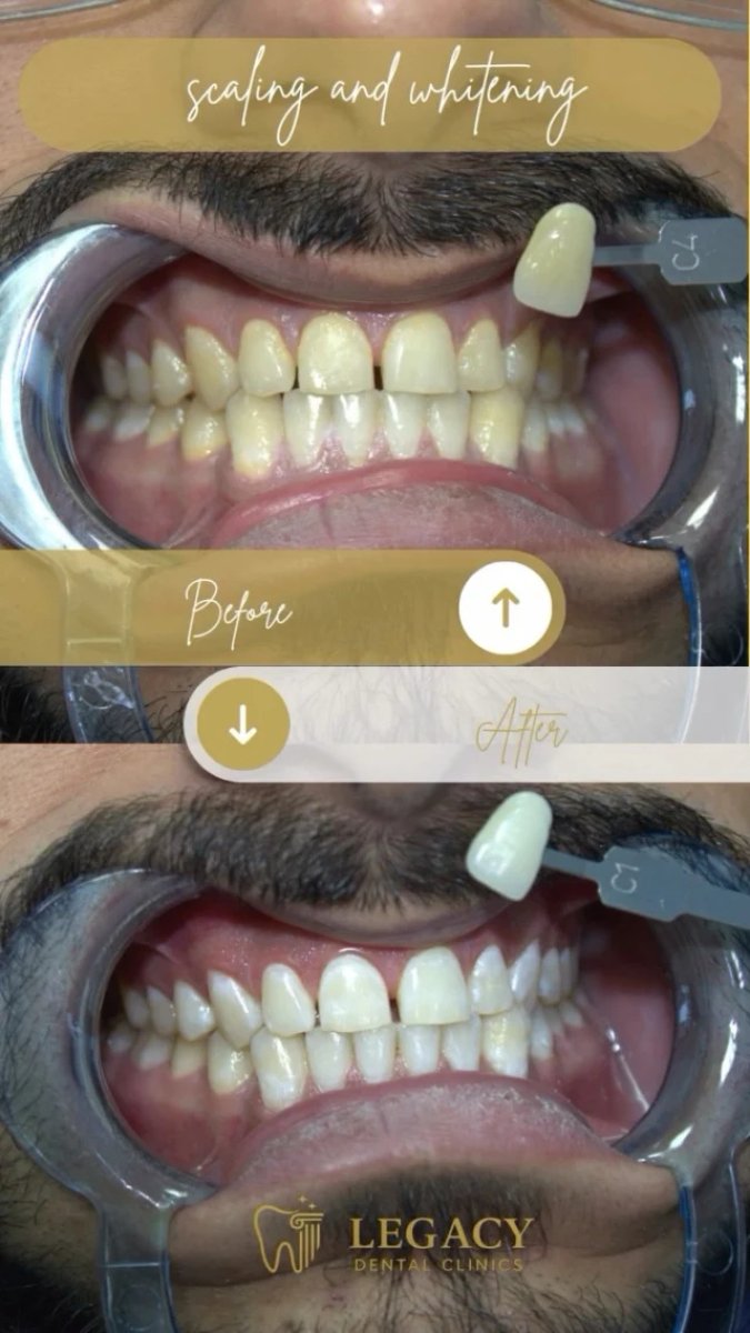 نتائج تبييض الأسنان قبل وبعد في Legacy Dental Clinics – ابتسامة أكثر إشراقًا بوضوح