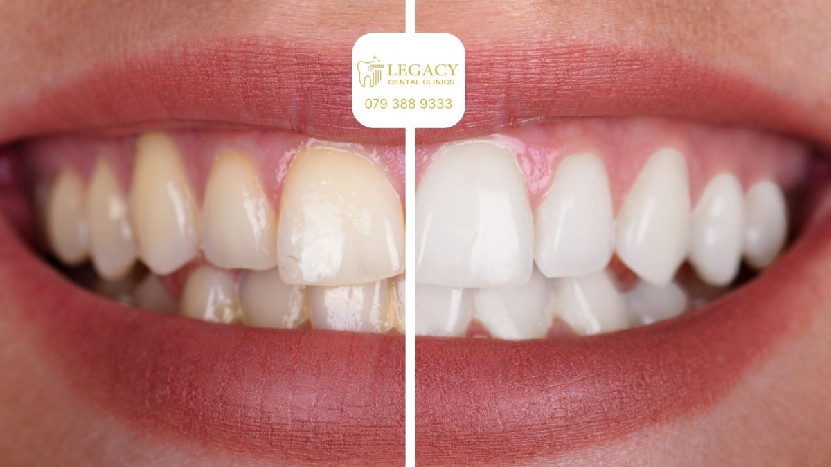 نتائج تبييض الأسنان قبل وبعد في Legacy Dental Clinics – ابتسامة أكثر بياضًا