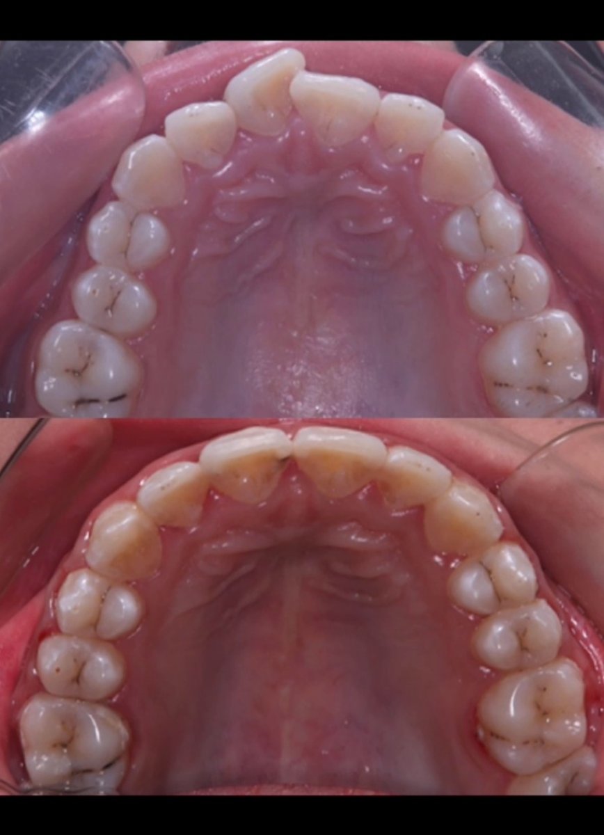 Résultats avant/après appareil dentaire – alignement amélioré des dents supérieures