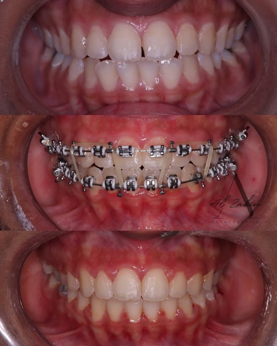 Before and after braces results at Al Zahiri Orthodontics – improved teeth alignment