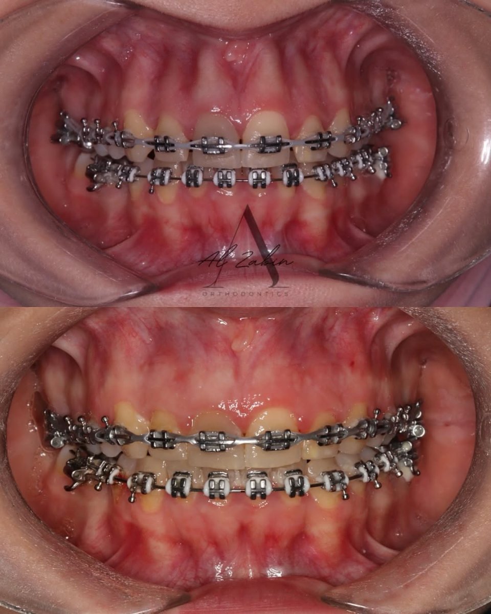 نتائج قبل وبعد تقويم الأسنان في Ali Zaidan Orthodontics – تحسين اصطفاف الأسنان