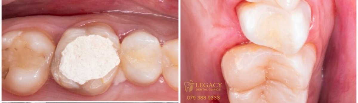 Vorher-nachher-Ergebnis Kompositfüllung bei Legacy Dental Clinics – Zahn wiederhergestellt
