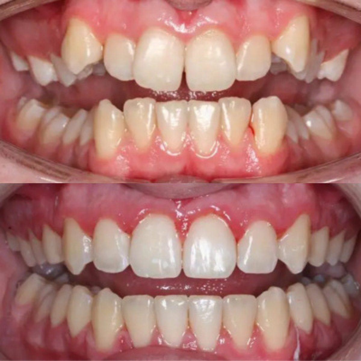 Результаты до и после Invisalign – выравнивание зубов после ортодонтического лечения