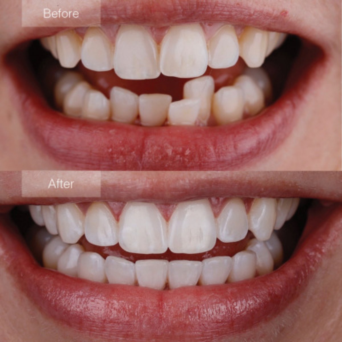 Before and after Invisalign results – teeth alignment and smile improvement at clinic