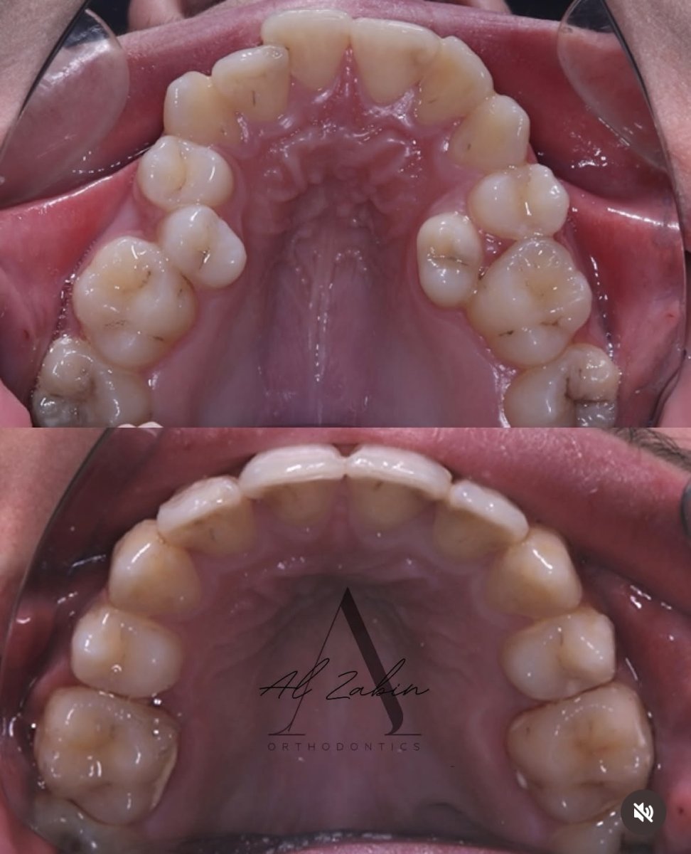 Résultats avant et après Invisalign chez Al Zakin Orthodontics – alignement dentaire amélioré