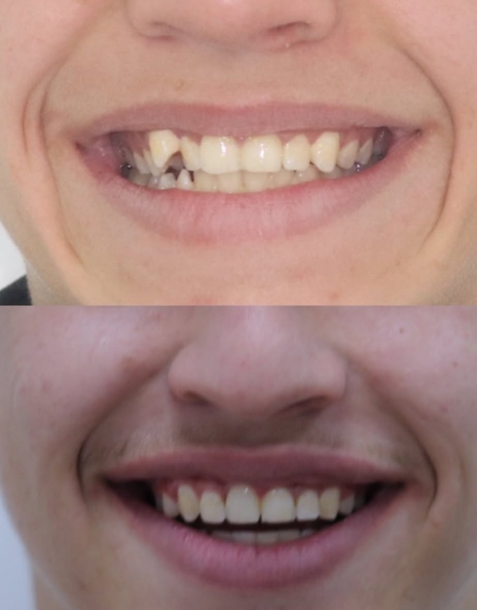 نتائج قبل وبعد تقويم Invisalign – تحسين انتظام الأسنان وتحول الابتسامة