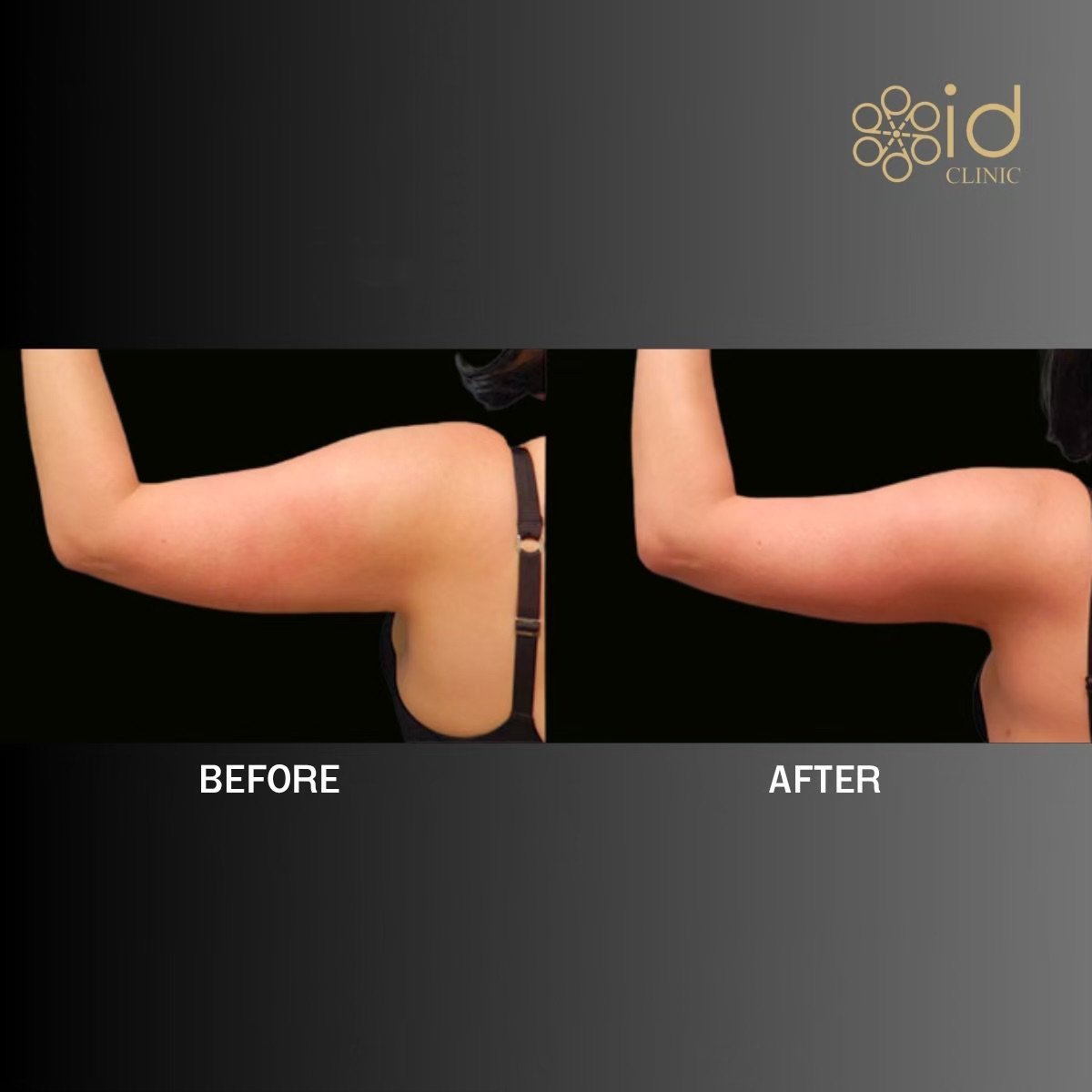 Before and after arm liposuction results at ID Clinic Bangkok, visible arm contour improvement