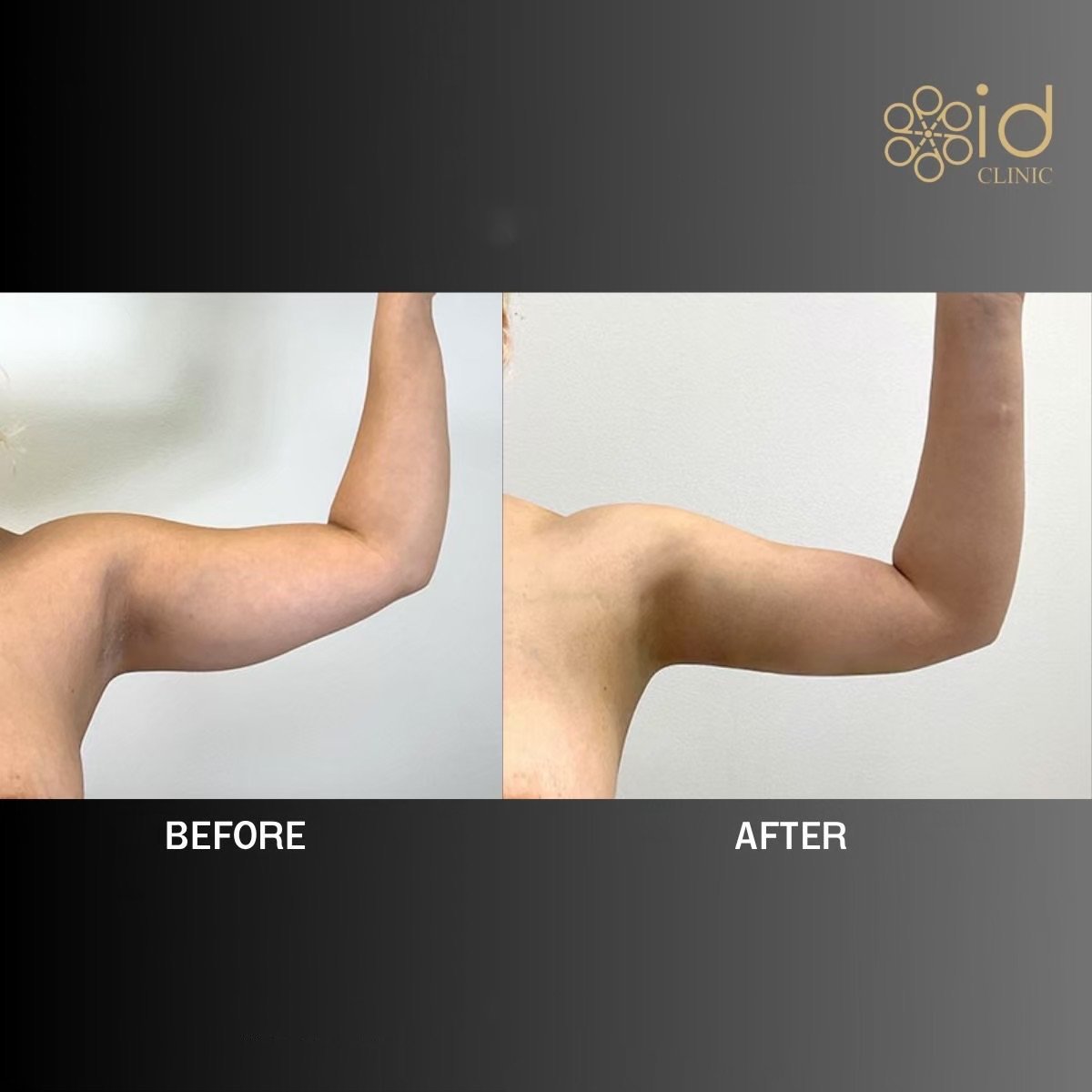 Vorher-nachher-Ergebnis der Armliposuktion bei ID Clinic Bangkok, verbesserte Kontur sichtbar