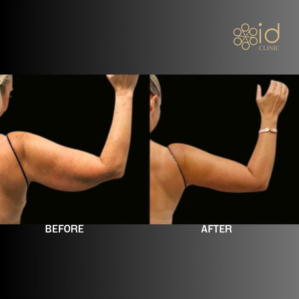 Resultados de liposucción de brazos antes y después en ID Clinic Bangkok, contorno mejorado