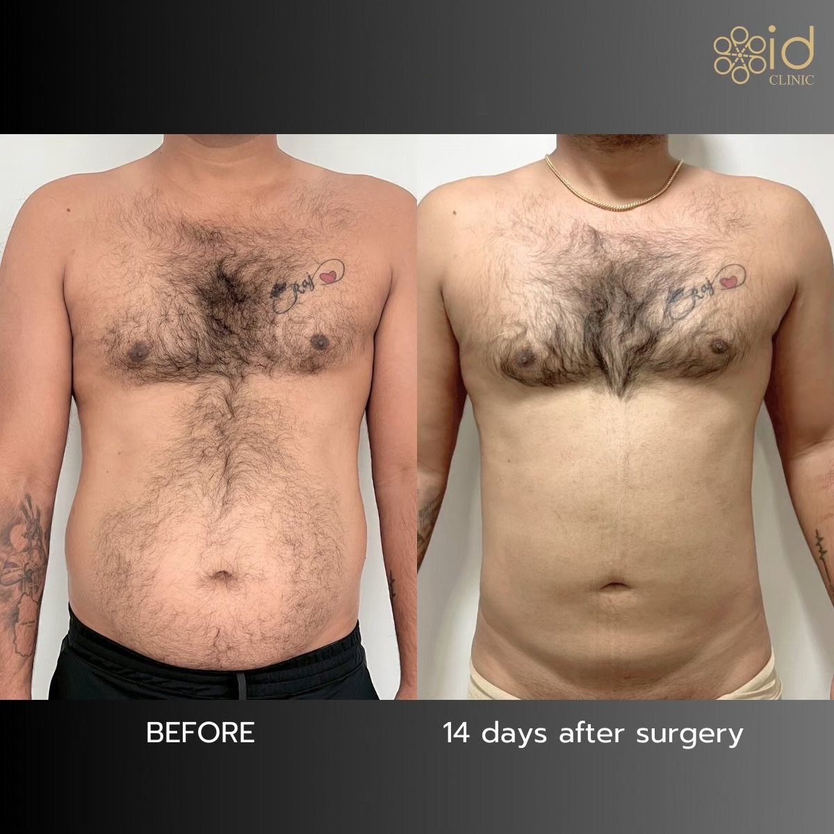 Before and after liposuction results at ID Clinic Bangkok, visible abdominal contour improvement