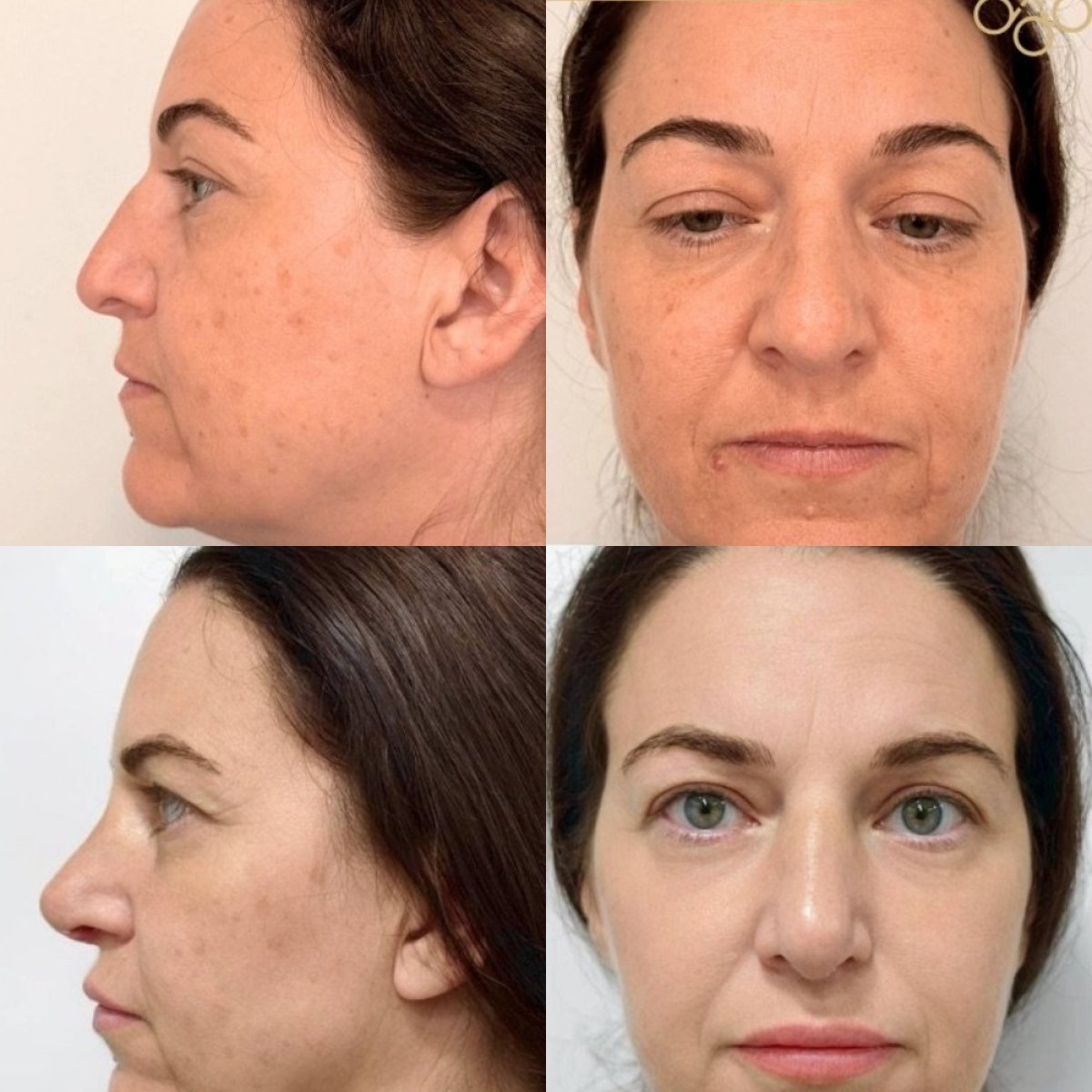 Before and after rhinoplasty results at ID Clinic Bangkok, nose reshaping with natural look