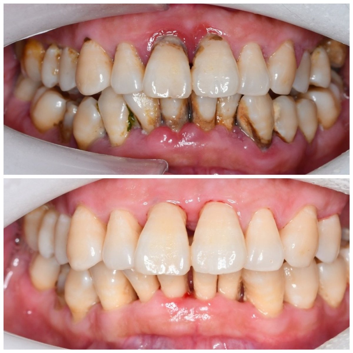نتائج قبل وبعد جينجيفيكتومي في عيادة Shanghai Y+bo Dental، تحسن صحة اللثة
