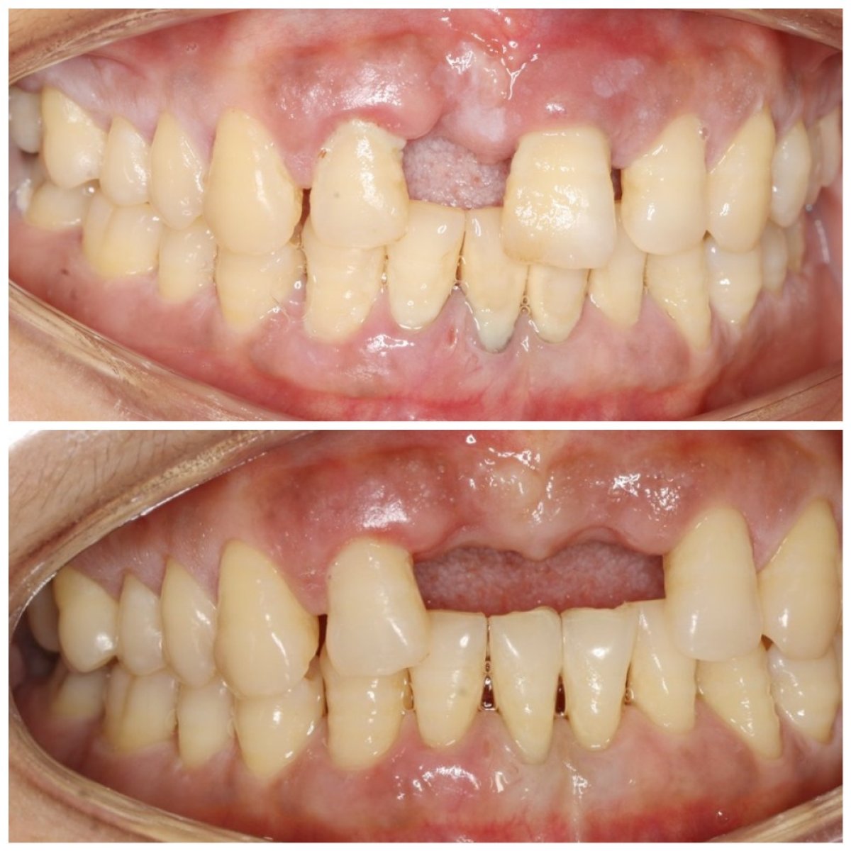 Before and after gingivectomy results at Shanghai Y+bo Dental Clinic, improved gum contour
