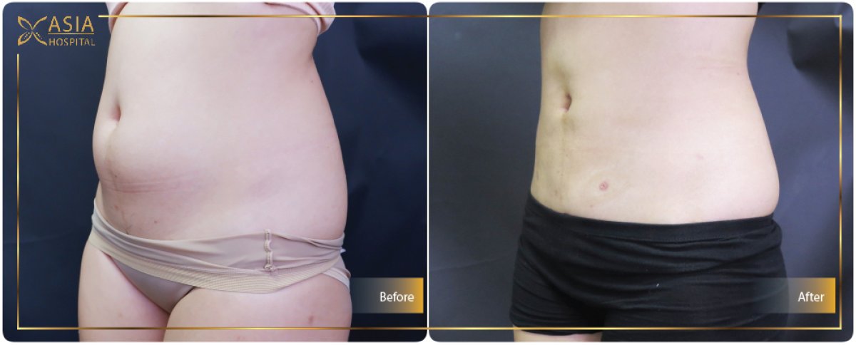 Résultats avant/après liposuccion 360 à Asia Cosmetic Hospital, silhouette affinée