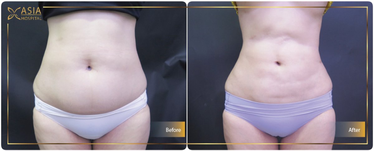 Résultats avant/après liposuccion 360 à Asia Cosmetic Hospital, taille affinée visible
