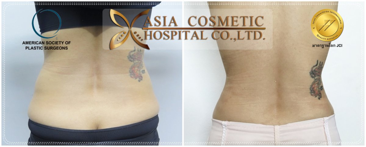 Результати 360 ліпосакції до і після в Asia Cosmetic Hospital, помітне моделювання талії