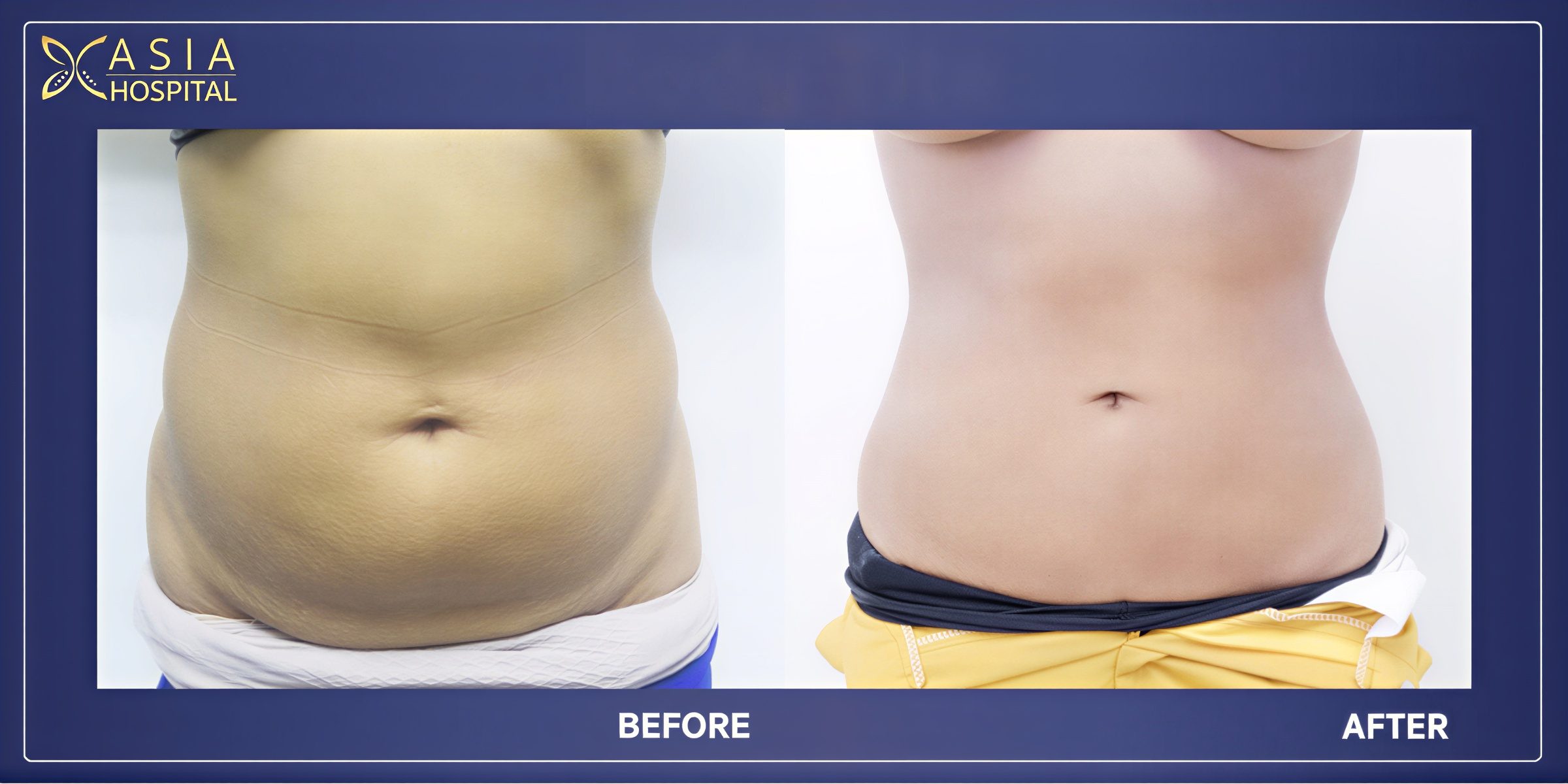 Resultados de liposucción 360 antes y después en Asia Cosmetic Hospital, cintura definida