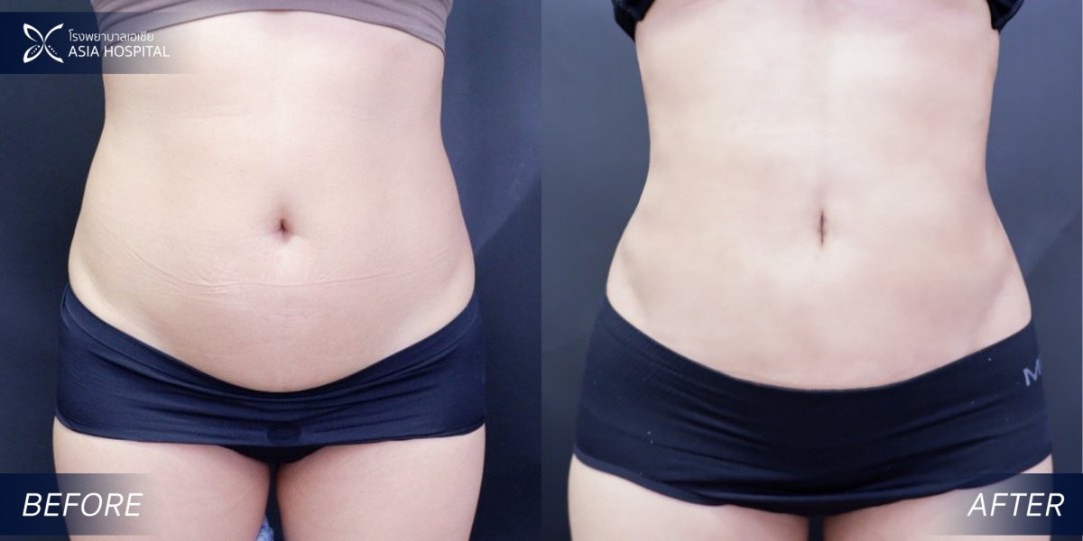 Before and after 360 liposuction results at Asia Cosmetic Hospital, visible waist contouring