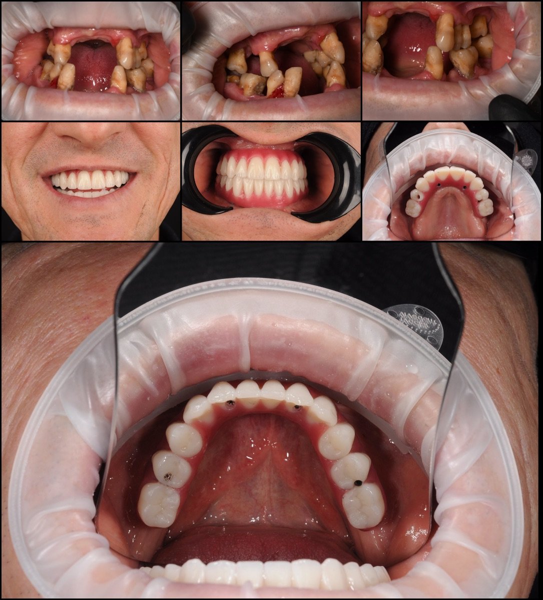 Vorher-nachher-Ergebnis All-on-6 Implantate bei RIKOTA Dental Clinic, vollständige Zahnsanierung