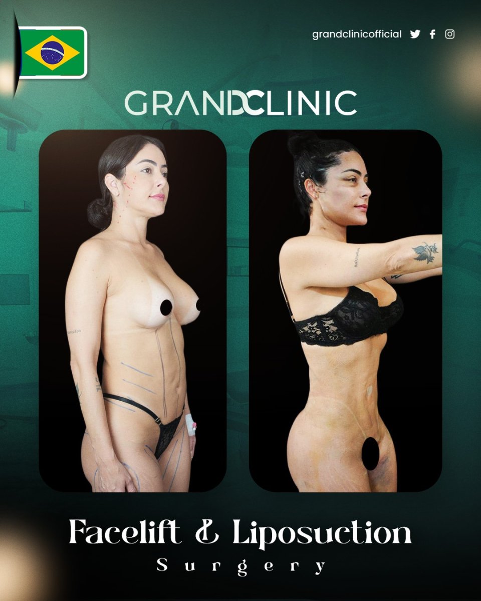 Before and after facelift and liposuction results at Grand Clinic, visible body contouring