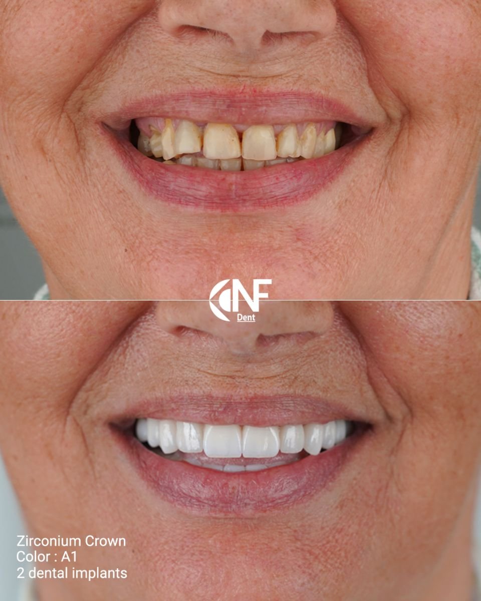 Before and after dental implant and zirconium crown results at Nifa Dent International clinic