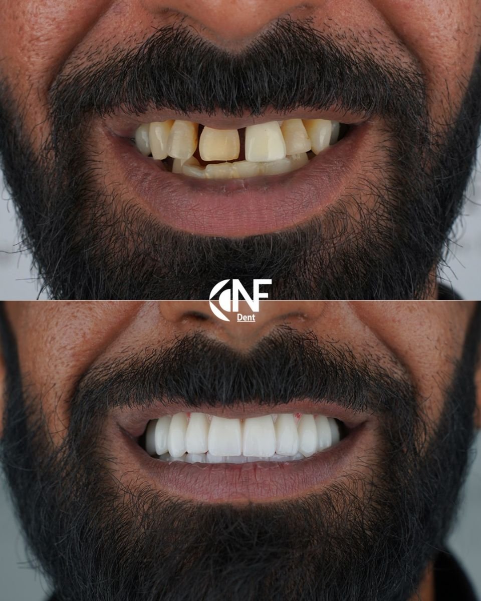 Before and after dental implant results at Nifa Dent International – restored smile transformation