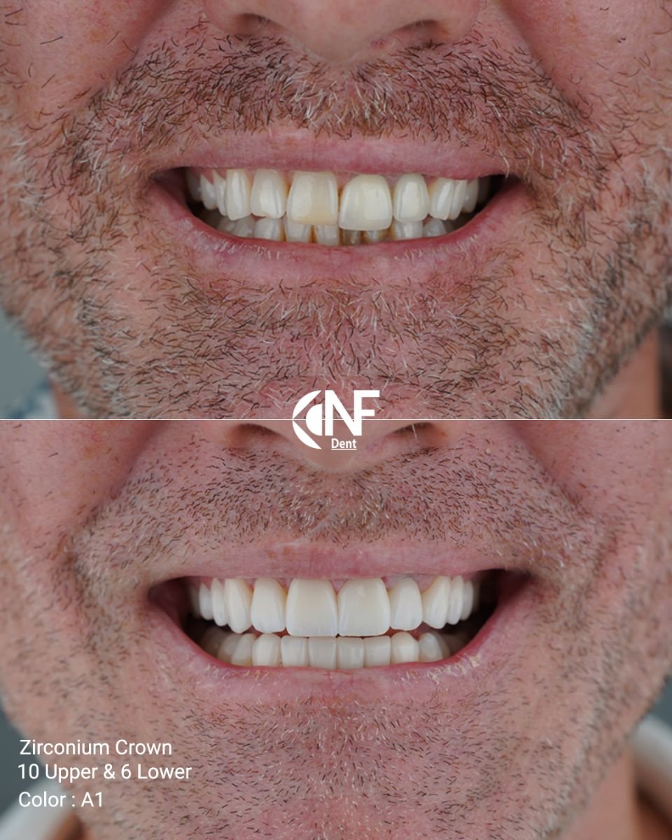 Before and after zirconia crown results at Nifa Dent International, improved smile aesthetics