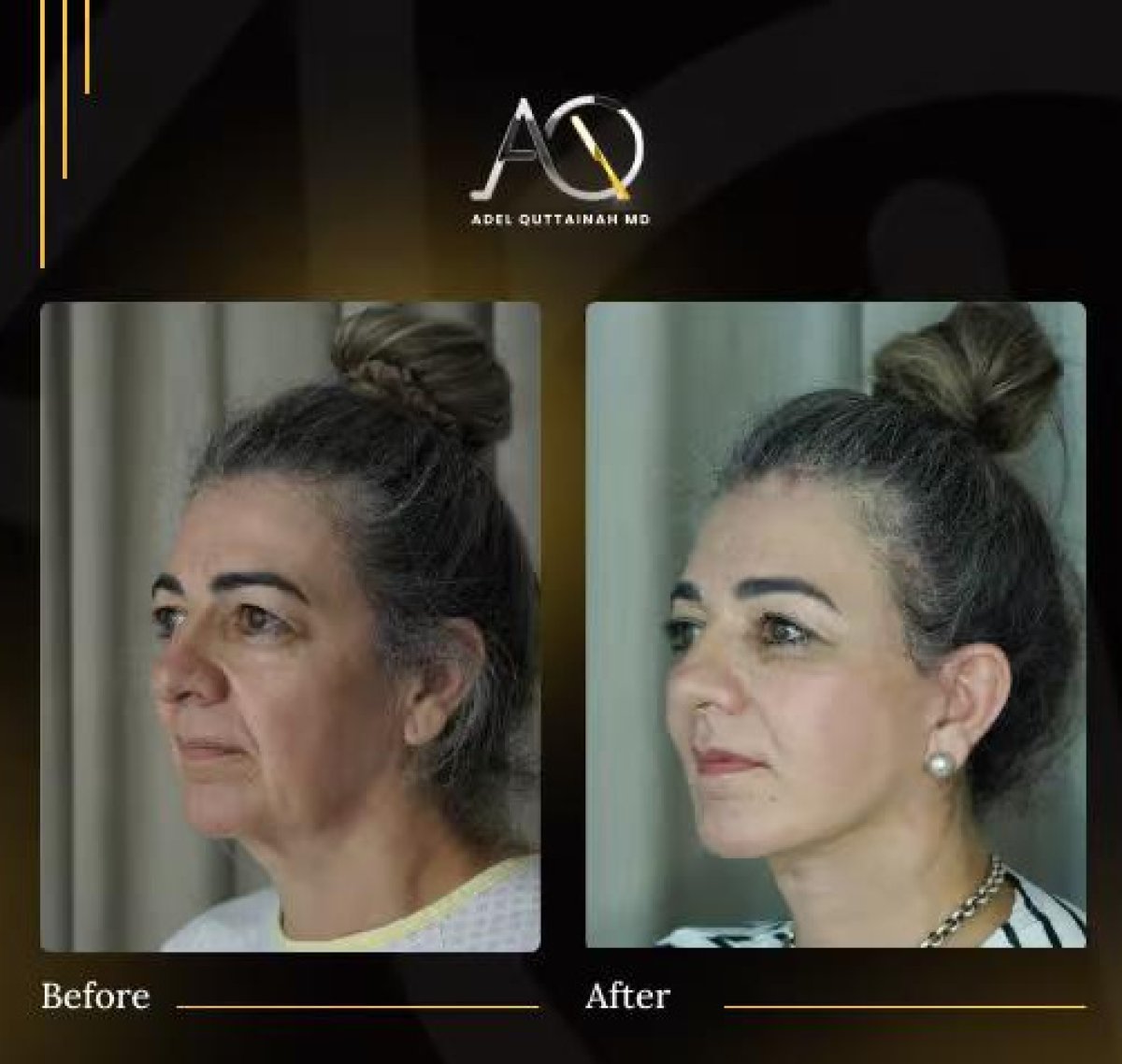 Facelift before and after results at Adel Quttainah MD clinic – visible facial rejuvenation