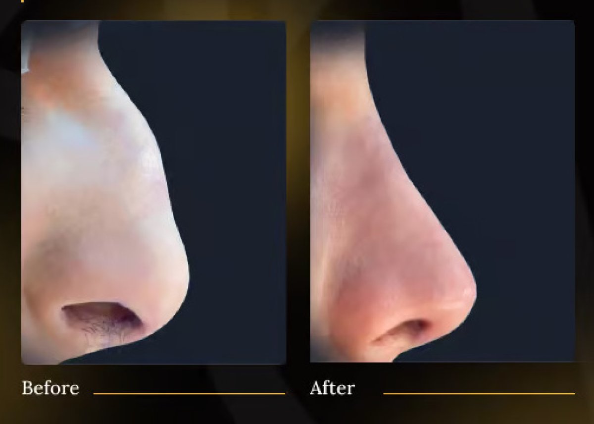 Before and after rhinoplasty results – nose reshaping with improved profile