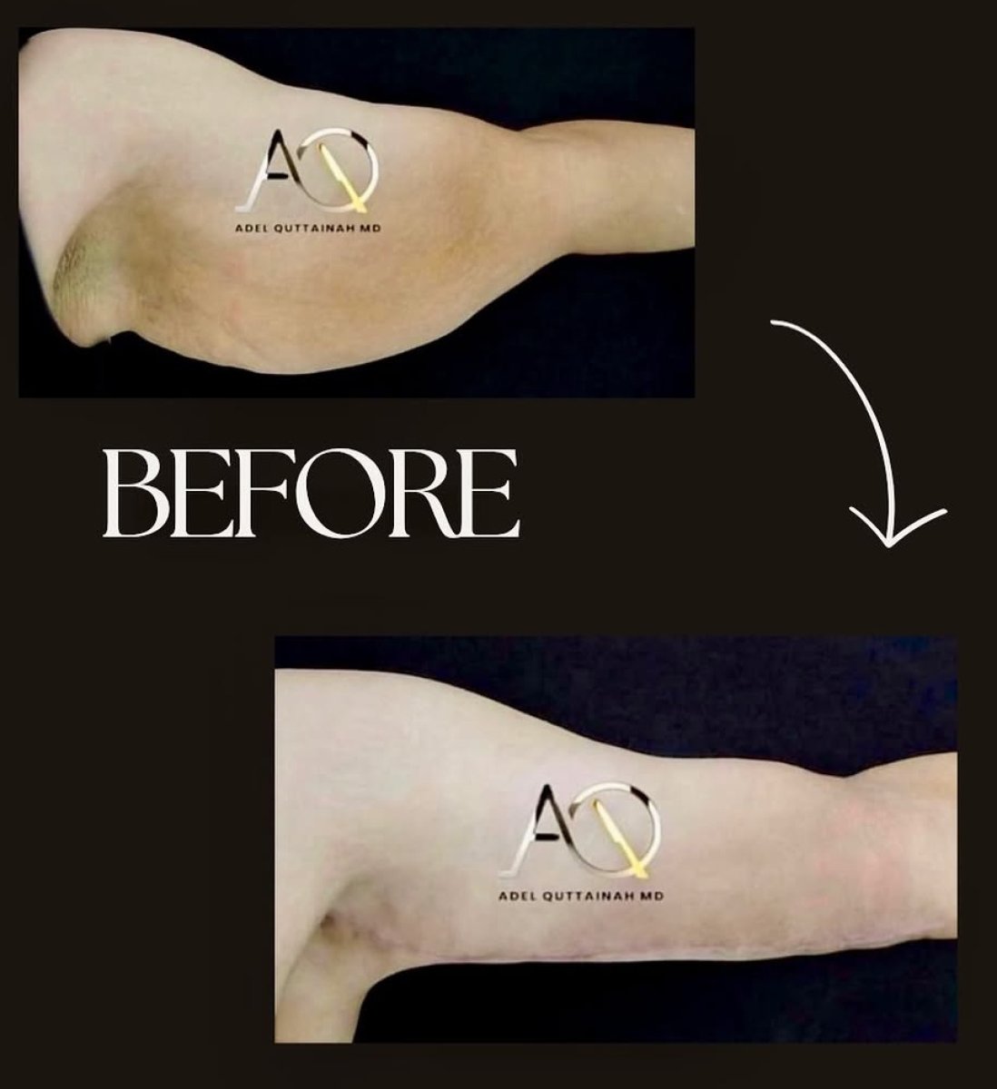 Before and after arm lift results at Adel Quttainah MD, improved arm contour after brachioplasty
