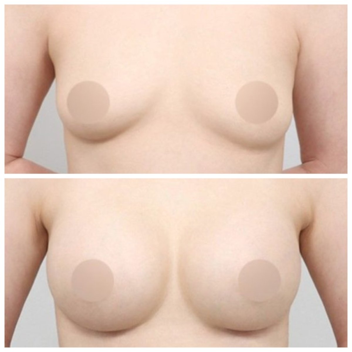 نتائج شد الثدي قبل وبعد في AB Plastic Surgery – تحسين شكل ورفع الثدي