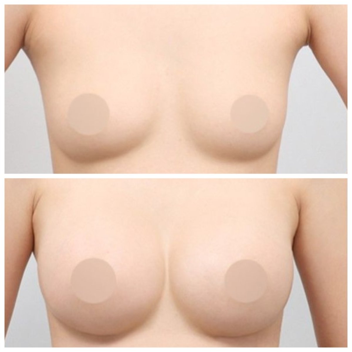 Результаты до и после подтяжки груди в AB Plastic Surgery – улучшенная форма и подтяжка